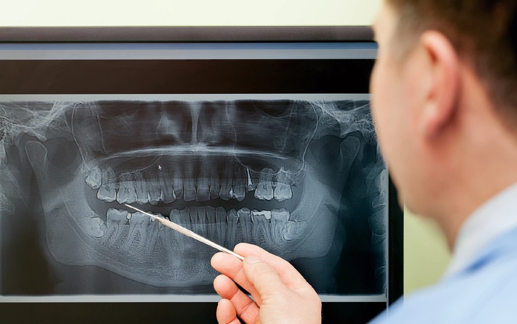 ZBOGOM IMPLANTI, PLOMBE I MOSTOVI Neverovatno otkriće naučnika: Zamislite da vam zub ponovo izraste za samo 9 nedelja