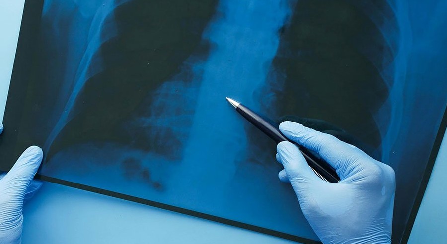 Zbog kašlja mislili da ima tumor, a onda je uslijedio šok: „Kad su ga izvukli, svi su se smijali“
